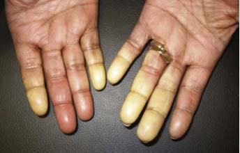 Raynauds