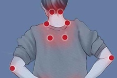 Fibromyalgia-