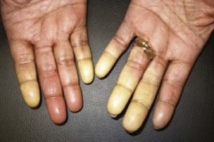 Raynauds